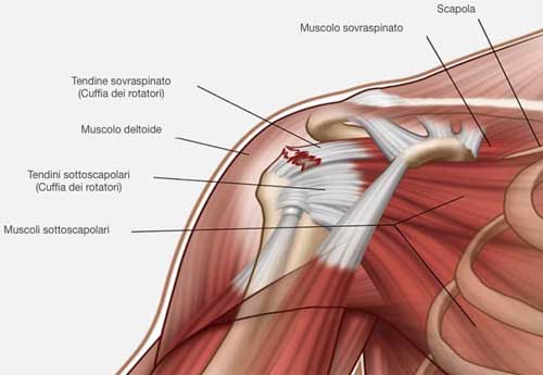 Lesione del tendine del muscolo sopraspinato